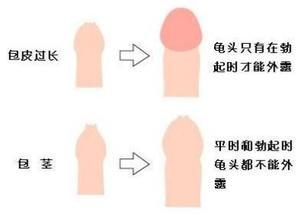 “男”言之隐——包皮过长会导致不育吗?