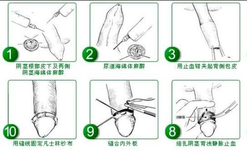 包茎的危害及治疗方法 阻塞 阻碍发育