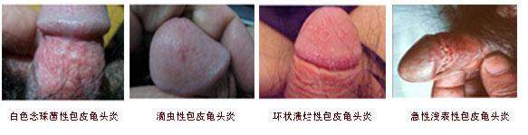 包皮龟头炎爱表演什么节目