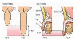 阴茎延长术有什么特点