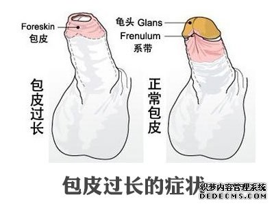 包皮过长给男性带来什么样的危害