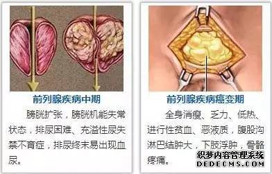 齐齐哈尔中都医院 前列腺炎，为何总是“阴魂不散”? 